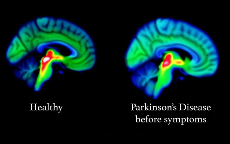 Un sistema automático para detectar el mal de Parkinson con un alto grado de precisión