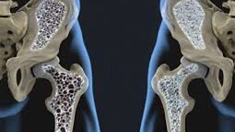 Investigadores de la UNLP usan nanotecnología para tratar la osteoporosis