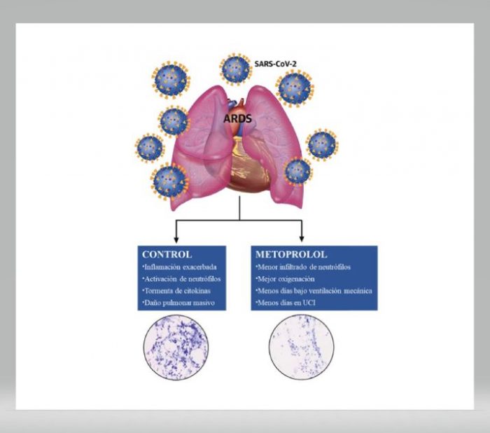 El fármaco metoprolol parece ser promisorio para tratar a pacientes críticos de COVID-19