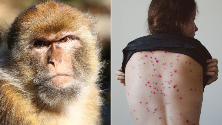 Viruela del mono: los mayores de 45 años están más protegidos contra el virus
