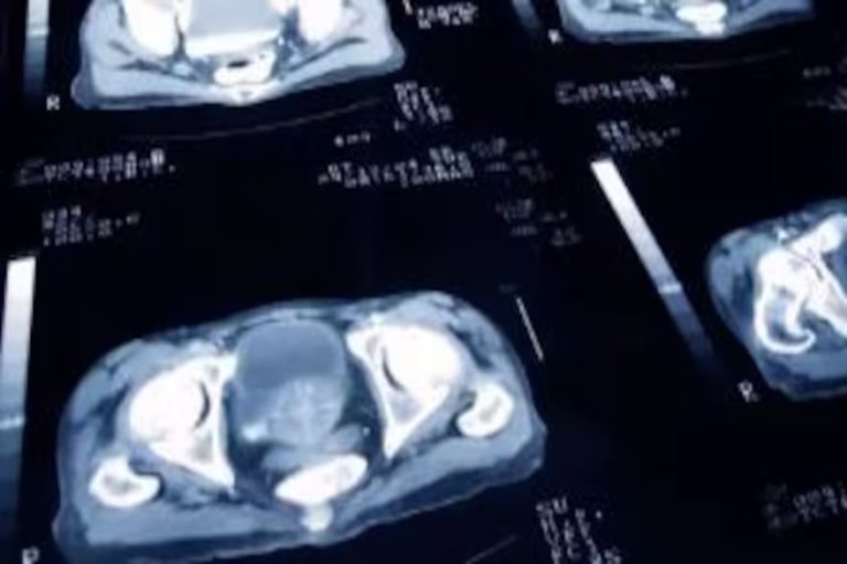 Un estudio revela que el cáncer de próstata se puede curar con menos sesiones de radioterapia