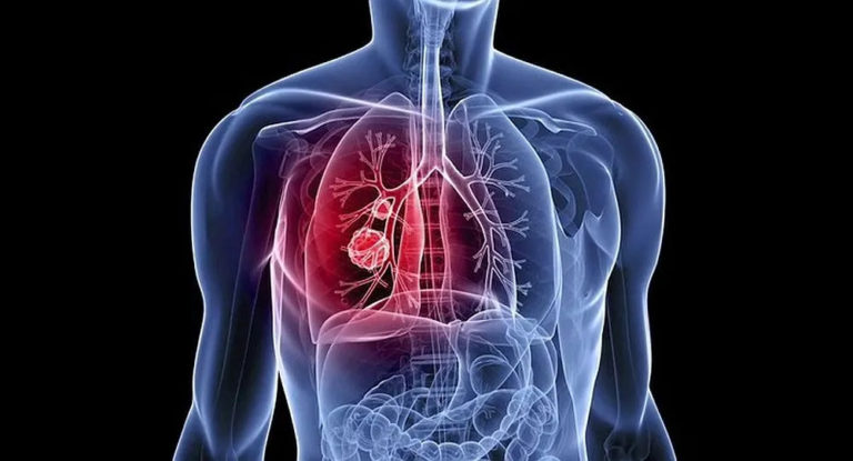 Un anticuerpo monoclonal para un tipo de cáncer de pulmón que no tenía tratamiento