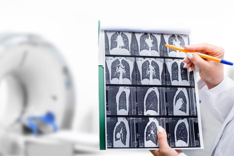 Un fármaco experimental combate un tipo de cáncer de pulmón, el quinto más mortal