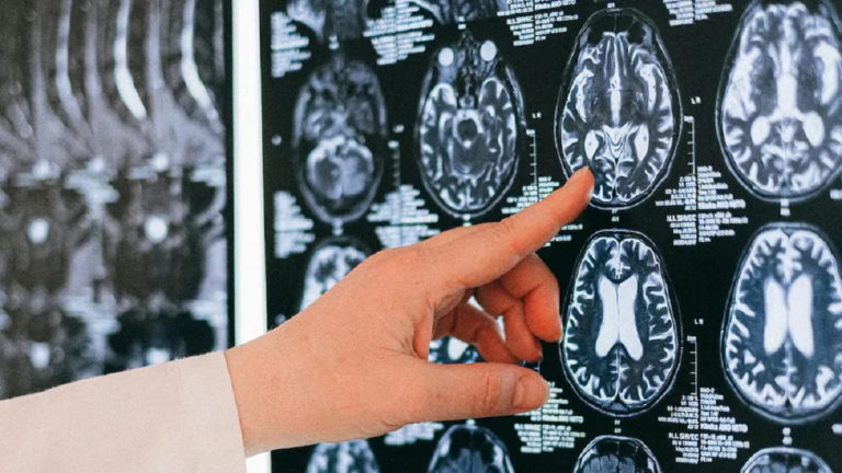 Un hospital patagónico, y una  investigación que identifica un gen que mejora la recuperación tras un ACV