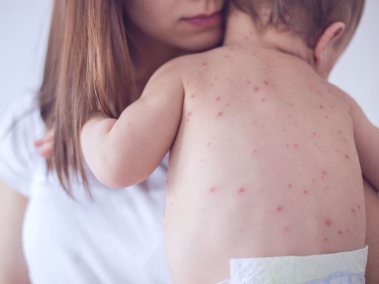 El sarampión regresó. Lo que es necesario saber
