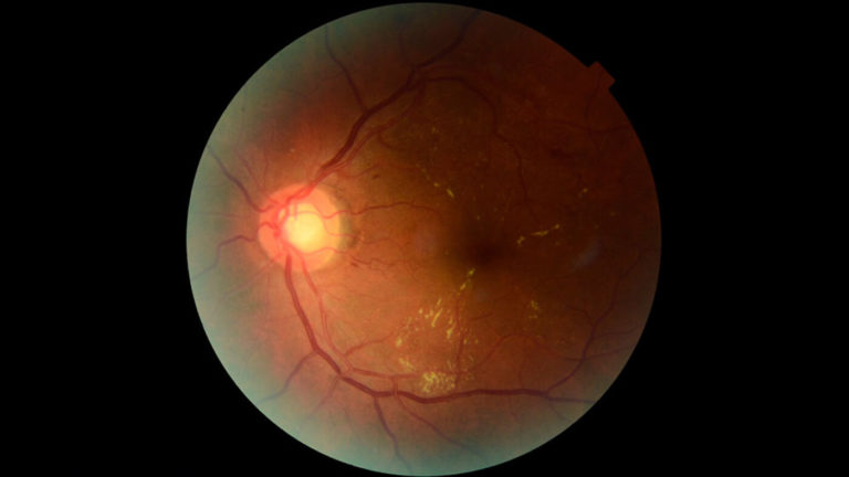 Retinar: la IA desarrollada en el CONICET para prevenir pérdida visual en personas con diabetes