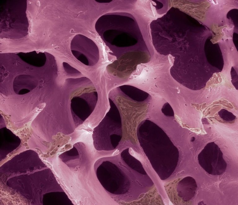 La osteoporosis afecta a millones: ¿podrían las células modificadas reconstruir sus huesos?