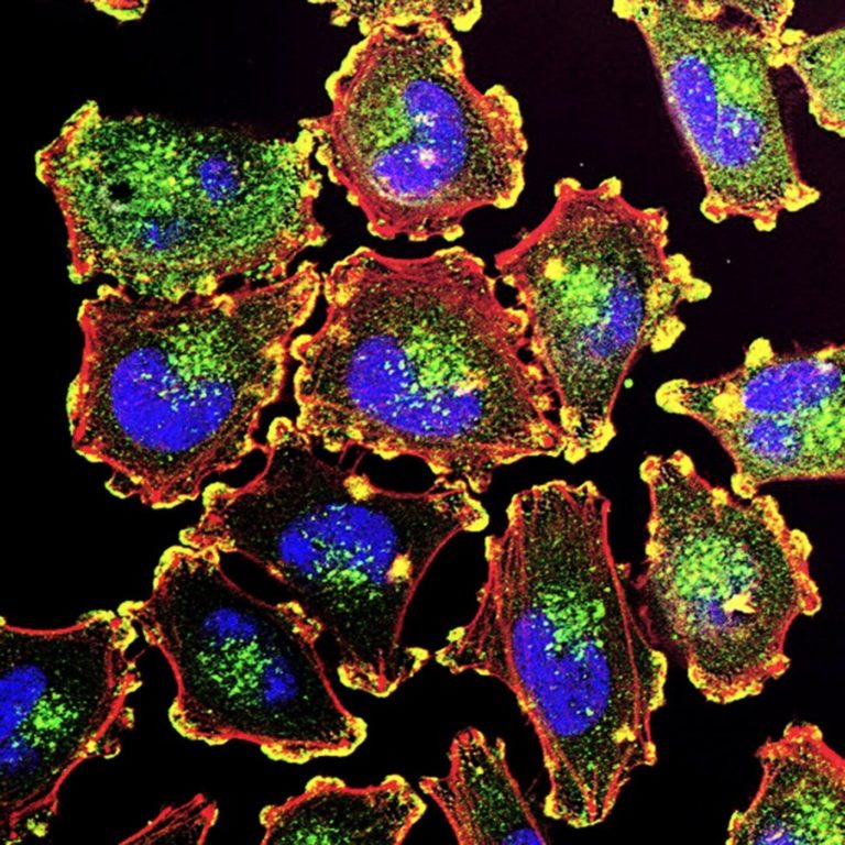La vacuna contra el cáncer de Moderna es un primer paso. Ahora, avanzar con las terapias personalizadas