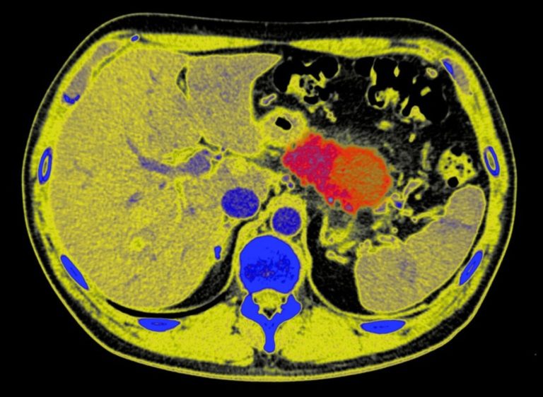 ¿Se puede detener el avance del cáncer de páncreas? Una nueva táctica da esperanza